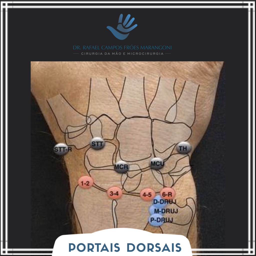 portais artroscopia de punho